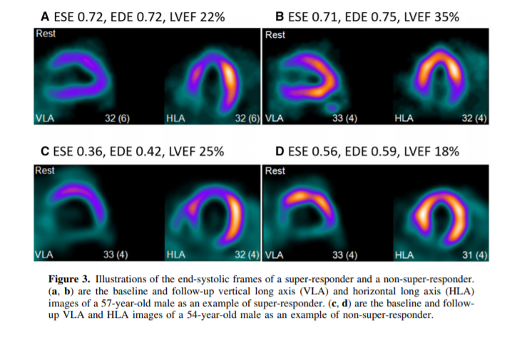 JNCjournal's tweet photo. #JournalNC: Can left ventricular shape parameters measured by #SPECT MPI identify super-responders to CRT? 

👉Learn more @ https://t.co/sedvPa0kTS            
#CVNuc @MyASNC @heartfailure @mtu_computing @ICC_MTU @LabMiil https://t.co/MEi8gGRO4v