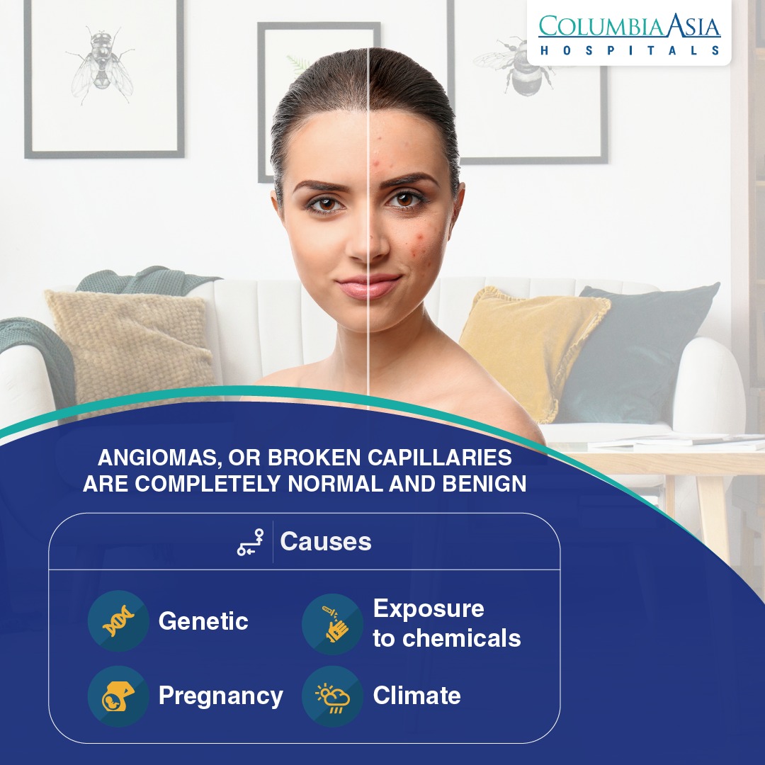 ColumbiaAsiaIn's tweet image. Ever wondered what those red spots that started developing on your skin could possibly be? Well, these are called Angiomas or broken capillaries.

#ItsNormal #ColumbiaAsiaIndia #ColumbiaCares #HealthierTogether #SkinCare #Angiomas #Dermatology #Dermatologist #HealthySkin