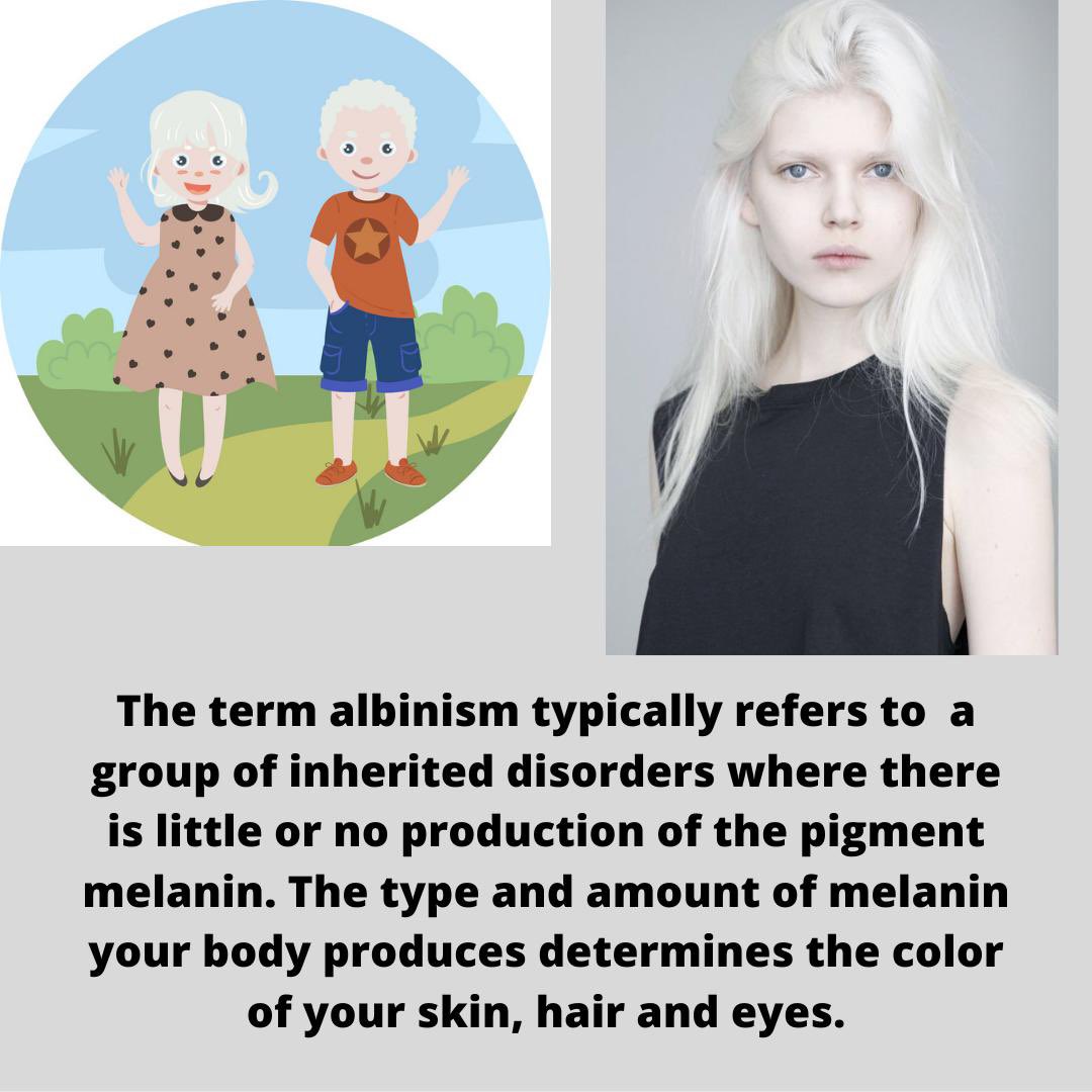 Having albino skin in your life is unique. Don’t be shy or scared because you are perfect just the way you are! Remember that everyone in this world are beautiful!! ❤️💕

#imperfectionisbeauty #truebeauty #adorayourself #selflove