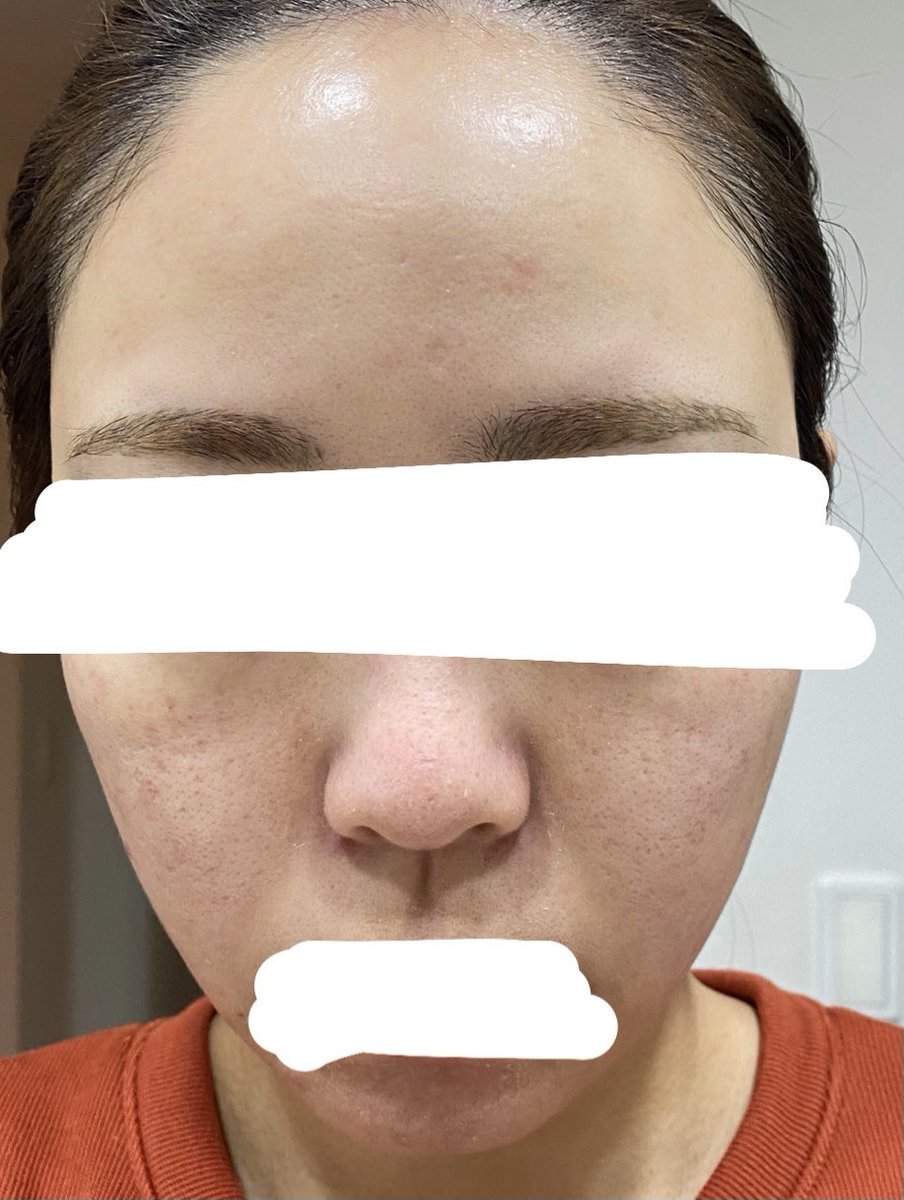 M 施術後3日目 夜 朝と比べて赤みや毛穴や乾燥は ほとんど変化なし アゴ 鼻周り 頬が皮が結構向けてきて少しむず痒いです 画像4枚目がわかりますいです ニキビがポツポツとできてきまし
