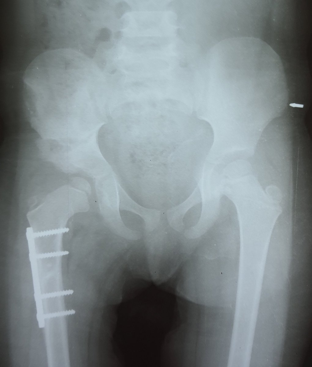 drAyesha_Saeed's tweet photo. Journey of a neglected DDH is tough on children, parents and care givers. Multiple visits, enduring pain and uncertainty beholds it. Early detection is the key. #schme #hipdysplasia #orthotwitter #medtwittter @HIPpyHipHealth @hiphope_network @dysplasiahip https://t.co/Bqu09yqBTt