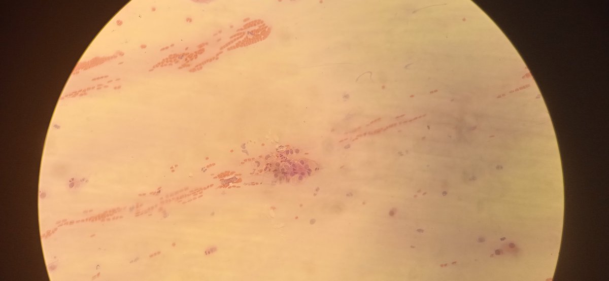 MinadjPath's tweet photo. Pap smear 44F https://t.co/b4O1l8jzaK