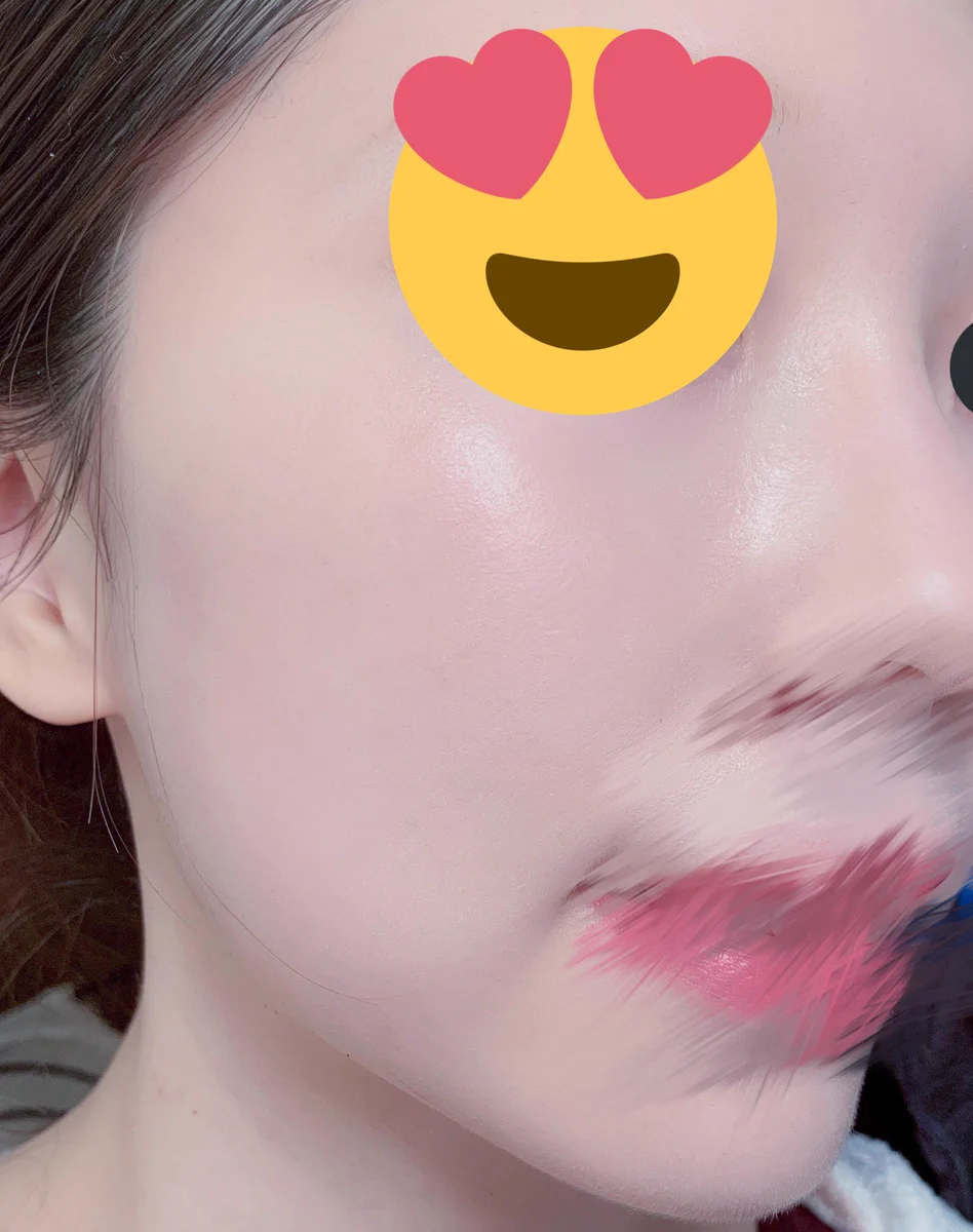 ニキビ跡に悩む人。純度の高いワセリンを盛塗って22時に就寝したら一日で目に見えて薄くなる。