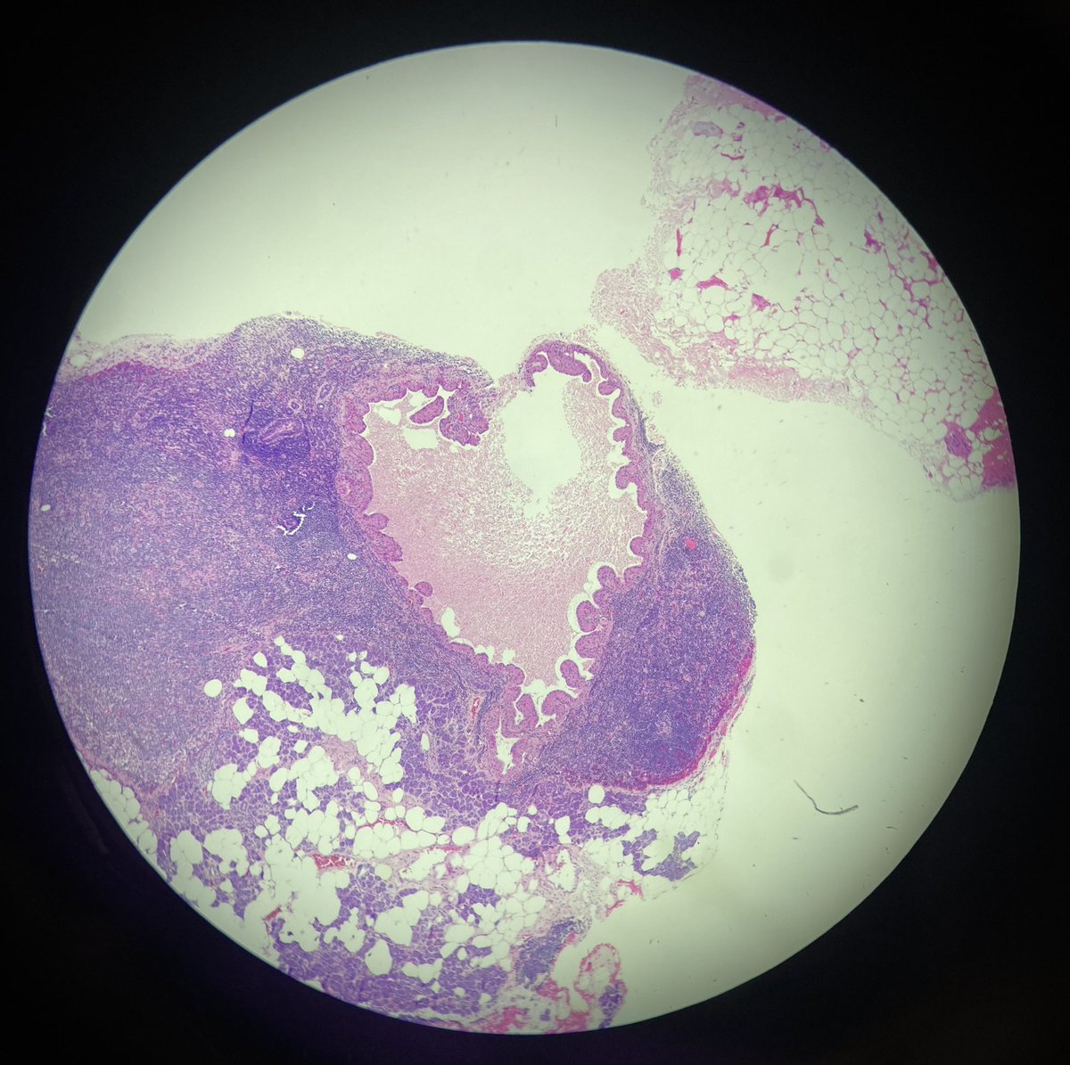 OentoroJaymie's tweet photo. This Warthin tumor was just a day late for Valentine’s Day
#HappyValentineDay #pathart #entpath #PathTwitter #pathology #warthin #tumor #parotid https://t.co/sFUxx5T7LX
