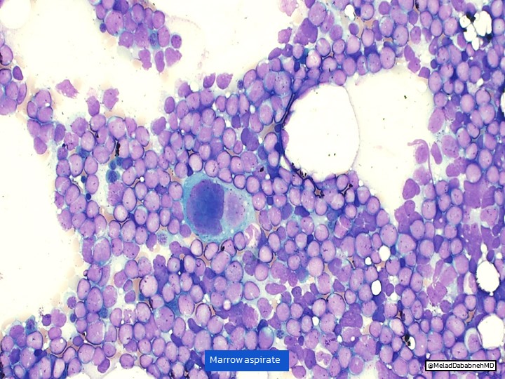 EmoryPathology's tweet photo. 🔬EMORY CASE OF THE WEEK #25

65 YOF presented with fatigue and anemia.

Answer the question below!

Contributor: @MeladDababnehMD

#EmoryCoTW #emorypathres #hemepath #CP #PathTwitter https://t.co/2CgUmHbJJ2
