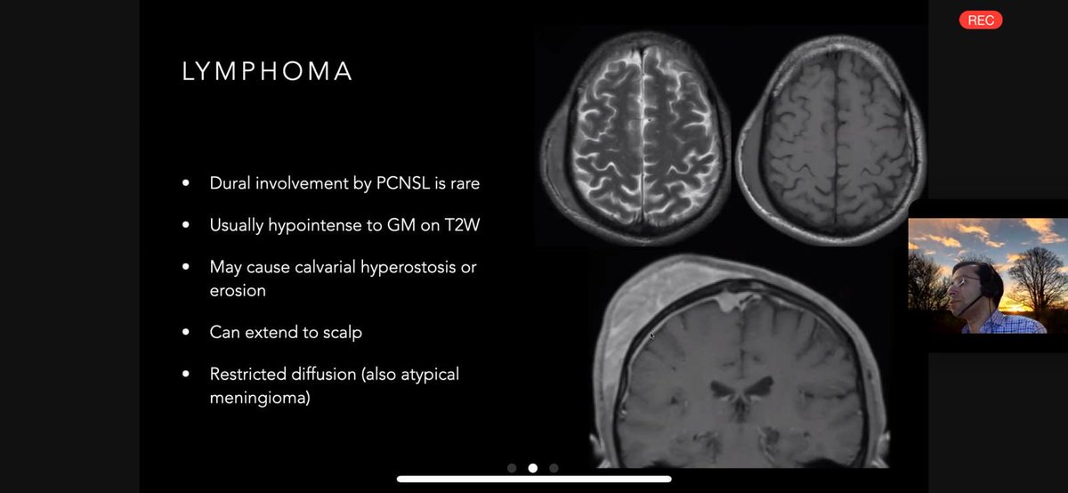 Dan Scoffings (@brainscandan) on Twitter photo 👏🏻Exemplary <a href="/theBSNR/">BSNR</a> Educational Programme webinar from <a href="/Das_neurorad/">Tilak Das</a> on Meningeal Tumours & Mimics. Beautiful slides, amazing cases, great use of <a href="/pacsbin/">Pacsbin.com</a> and fantastic delivery. <a href="/BSNRTrainees/">BSNR Trainees</a> <a href="/RCRadiologists/">The Royal College of Radiologists</a> #FOAMrad #neurorad 👏🏻Exemplary <a href="/theBSNR/">BSNR</a> Educational Programme webinar from <a href="/Das_neurorad/">Tilak Das</a> on Meningeal Tumours & Mimics. Beautiful slides, amazing cases, great use of <a href="/pacsbin/">Pacsbin.com</a> and fantastic delivery. <a href="/BSNRTrainees/">BSNR Trainees</a> <a href="/RCRadiologists/">The Royal College of Radiologists</a> #FOAMrad #neurorad