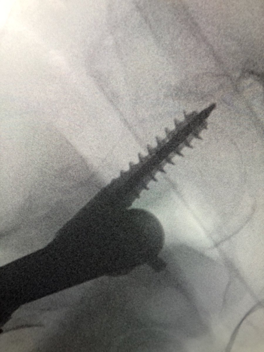 [2/2] This resulted in a completely different (anterior) trajectory of screw placement (left), which then had to be corrected (right). So always check.