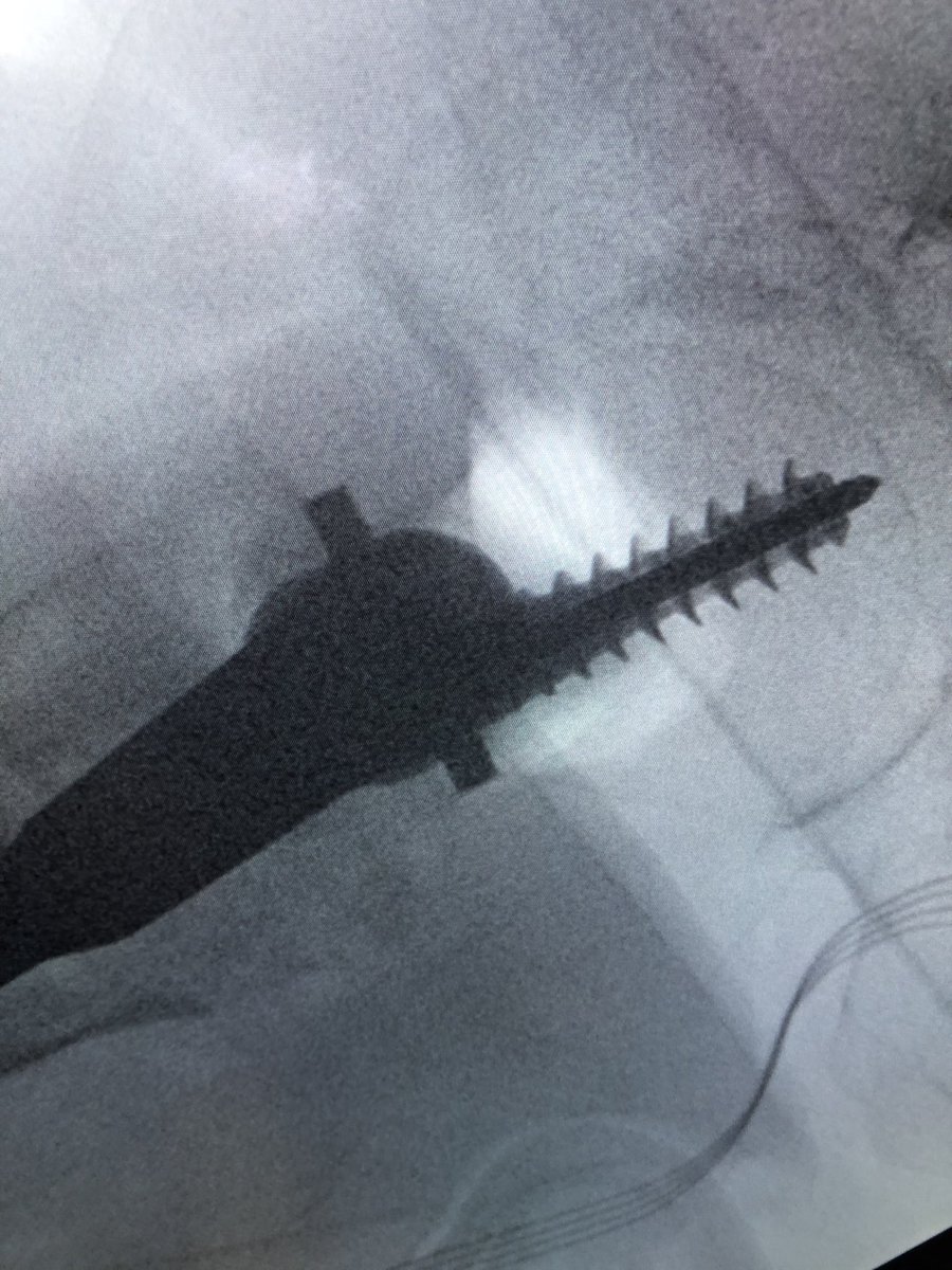 [2/2] This resulted in a completely different (anterior) trajectory of screw placement (left), which then had to be corrected (right). So always check.