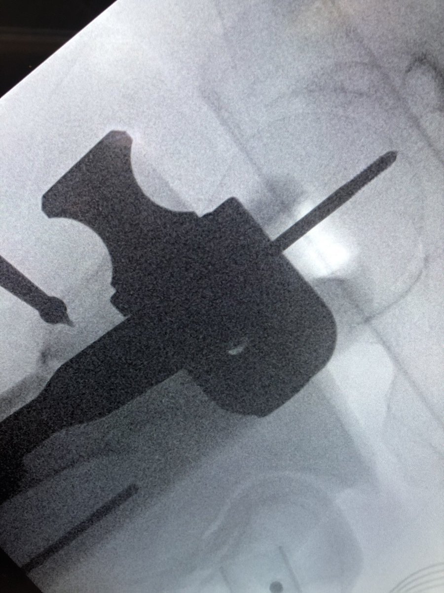 [1/2] Always make sure your wire stays where you put it. The original wire placement for drilling was this, but after drill came out so did the wire, and the screw was placed over the wire without ascertaining that it was back in proper position...