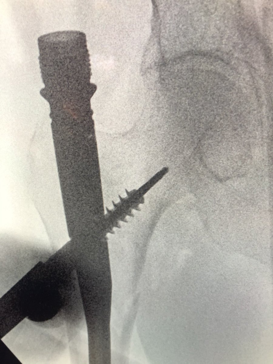 [1/2] Always make sure your wire stays where you put it. The original wire placement for drilling was this, but after drill came out so did the wire, and the screw was placed over the wire without ascertaining that it was back in proper position...