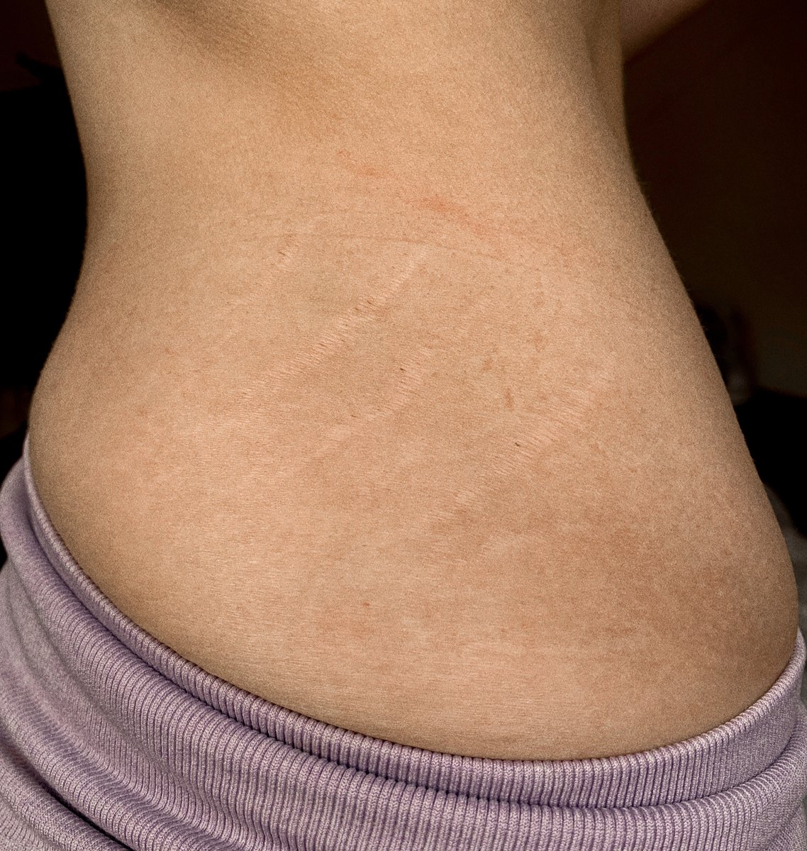 BodyLumpsBumps's tweet photo. Stretch marks are natural
Tag your besties to remind them that their stretch marks are gorgeous!
#bodypositivity #bodypositive #body #beautiful #loveyourbody #bodyacceptance #bodylove #love #positive #positivity #bodyimage #bodypositivitymovement #stretchmarks https://t.co/WzFHL1eOGt