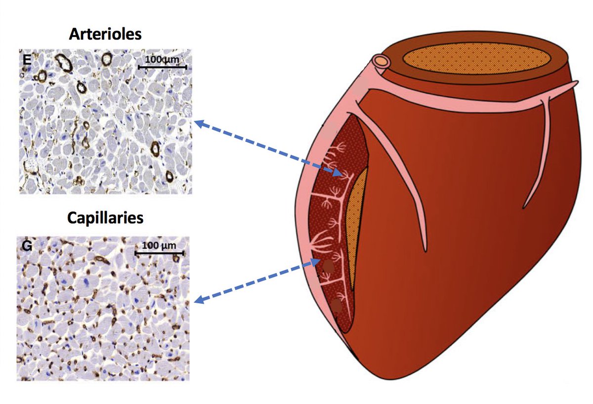 Join us on February 16th to discuss one of the major causes of microvascular dysfunction: structural remodelling. The 4th episode of our webinar series on INOCA, with a focus on invasive and non-invasive tests bit.ly/2Zqae1D @divaka_perera @eva_prescott @unicomplutense