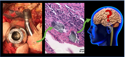Biocompatibility & Implant Pathology Lab (@rushimplantlab) on Twitter photo Learning more every day about the interaction of the #MSK system and the rest of the #body. @Robin_Pourzal explores this in his talk on #implant particle dissemination and #Alzheimers disease, Session 21, 0126. <a href="/ORSsociety/">Orthopaedic Research Society</a> #ORS2021 #ORSnation #orthotwitter Learning more every day about the interaction of the #MSK system and the rest of the #body. @Robin_Pourzal explores this in his talk on #implant particle dissemination and #Alzheimers disease, Session 21, 0126. <a href="/ORSsociety/">Orthopaedic Research Society</a> #ORS2021 #ORSnation #orthotwitter