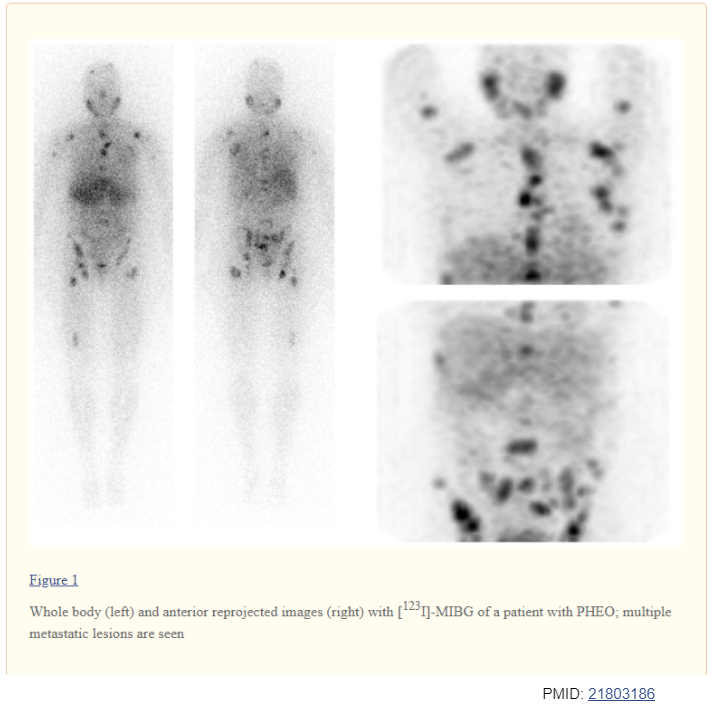 17/ MIBG Scintigraphy:Iobenguane I-123 is a compound similar to NEUptake at adrenergic tissueUptake in normal adrenals can by asymmetricalCorrelate with CT/MRIPMID: 21803186
