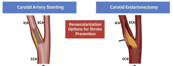 CCO is traditionally a high-risk feature for CEA and a reason to refer patients for CAS. Recent observational data contradicts this and suggests that CCO should no longer be considered high-risk for CEA in contemporary practice.