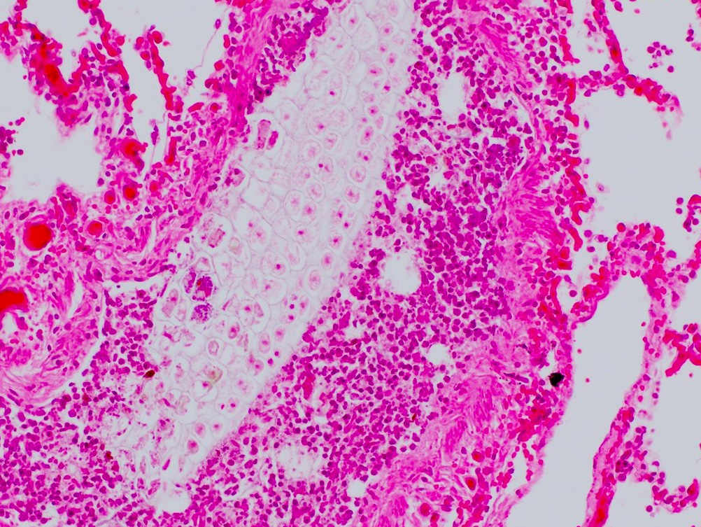  #MTPathUnknown #200 AThis tweet is 8 images (1/9).Purpose: discuss use of postmortem histology  @AmberMBerumen For medical students & residents: what is diagnosis for each? For all, how many of these microscopic exams were NECESSARY to determine underlying cause of death?