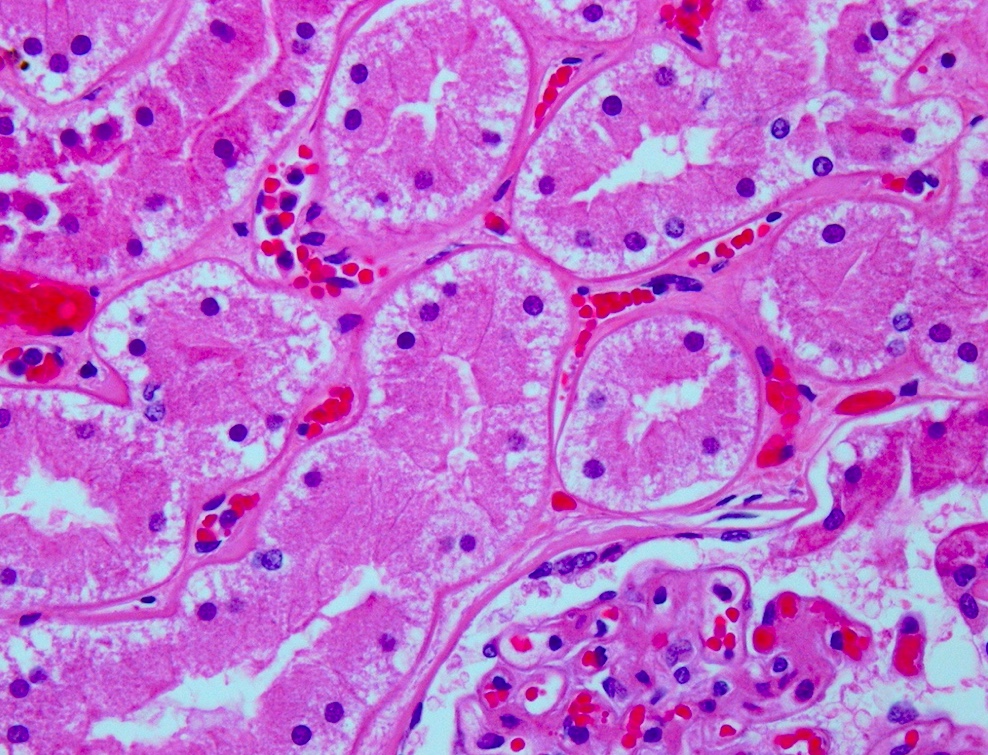  #MTPathUnknown #200 CImage Three (3/9)For medical students: what is the histologic abnormality (just describe what you see-I don't expect you to necessarily know the specific name/disease association)For pathology residents: what is the likely disease association(s)?