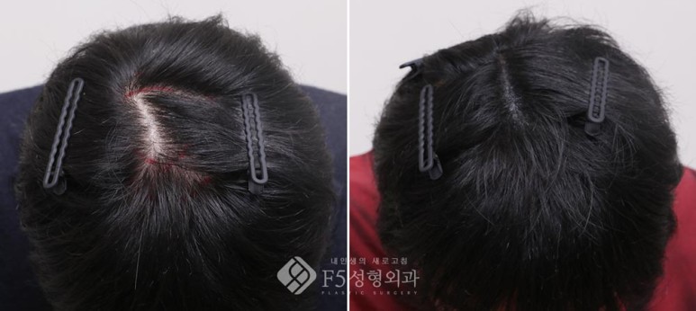 f5_scalp's tweet image. F5頭皮クリニック | 30代男性の頭頂部の薄毛・ヘアタトウー(SMP)の症例
⇒ameblo.jp/f5scalp/entry-…

#F5整形外科 #韓国整形 #脱毛 #薄毛 #ヘアタトゥー #M字 #プロペシア #SMP #抜け毛 #脱毛症 #植毛