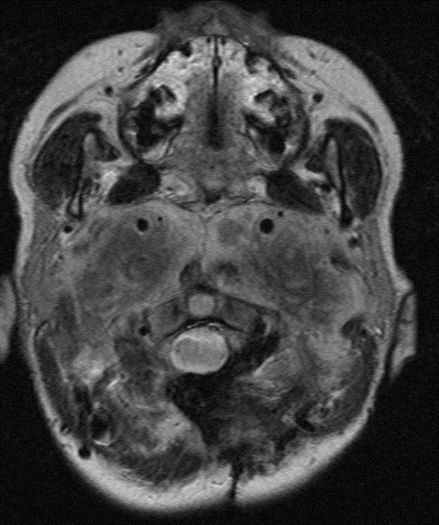#Neuroquiz: What is the most likely diagnosis of this skull base mass in a 15 year old girl?