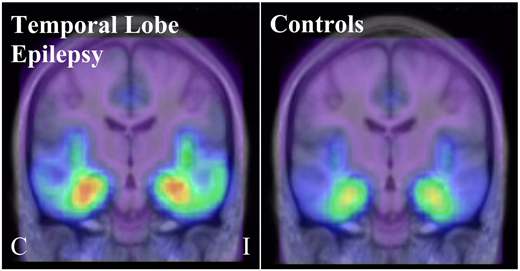 @BrainComms (@braincomms) on Twitter photo McGinnity et al. found that individuals with temporal lobe epilepsy, but normal structural imaging had reduced memory performance and bilaterally higher temporal lobe α5, but lower α1/2/3 in the ipsilateral hippocampus. bit.ly/3rQchbI <a href="/Hammers_Alexand/">Alexander Hammers</a> @colm_j_m McGinnity et al. found that individuals with temporal lobe epilepsy, but normal structural imaging had reduced memory performance and bilaterally higher temporal lobe α5, but lower α1/2/3 in the ipsilateral hippocampus. bit.ly/3rQchbI <a href="/Hammers_Alexand/">Alexander Hammers</a> @colm_j_m