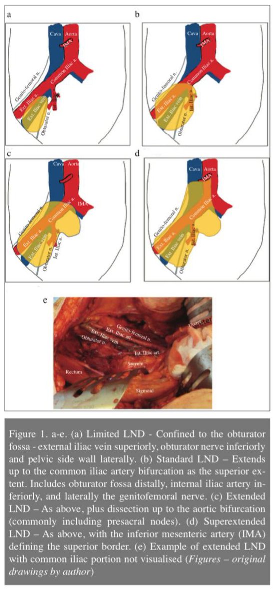 TurkJUrol's tweet image. The role of extended lymph node dissection in patients undergoing radical cystectomy

#bladdercancer #lymphnodedissection #cystectomy #UroSoMe 

@endouro @Uroweb @AmerUrological @UroOnc @EAU_Uroonco

Article Link :
 pubmed.ncbi.nlm.nih.gov/33052839/