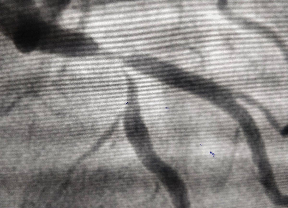 cardio_gotya's tweet photo. @varshit_hathi @sbh0012 @Sagar13desai @SujalShetty2 @Sameerpgi One of those satisfying wirings/PTCAs🙂
Crossed with whisper.
#cardiotwitter #ICtwitter https://t.co/tjvMs1qsT9
