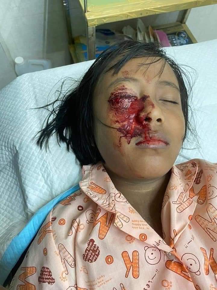 JulieMi33234076's tweet photo. Due to Myanmar Military and police forces'violence action against people yesterday (15/02/2021), a girl who live in their own appartment from Mandalay city, lost her eye. We condemn their breach action against civilian. NO MORE VIOLATION #WhatsHappeningInMyanmar #Feb16Coup https://t.co/tJT7yilV1g