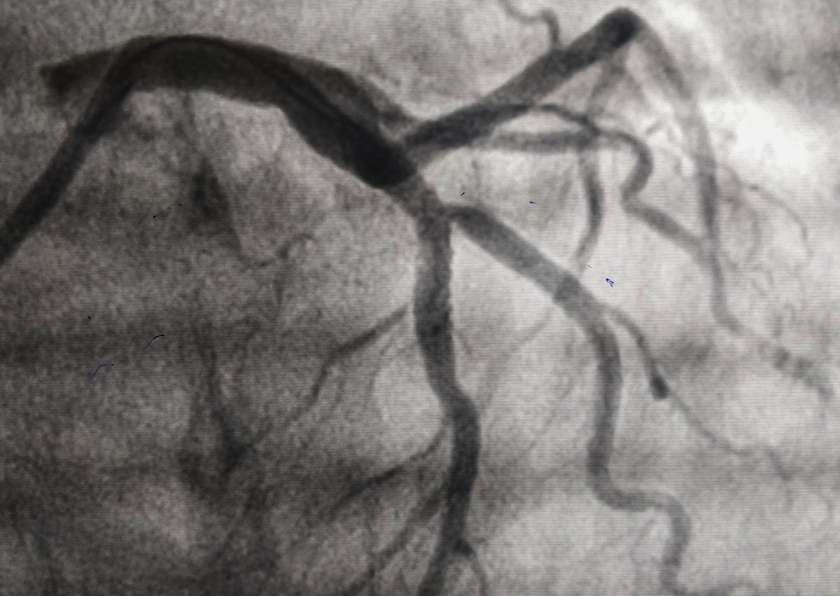 cardio_gotya's tweet photo. @varshit_hathi @sbh0012 @Sagar13desai @SujalShetty2 @Sameerpgi One of those satisfying wirings/PTCAs🙂
Crossed with whisper.
#cardiotwitter #ICtwitter https://t.co/tjvMs1qsT9