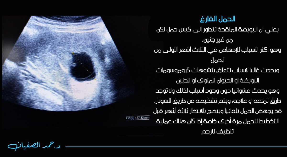 د. حمد الصفيان on X: "الحمل الفارغ 🤰❌ يعني ان البويضة الملقحة تتطور الى كيس  حمل لكن من غير جنين. وهو أكثر الأسباب للإجهاض في الثلاث أشهر الأولى من الحمل  ويحدث غالبا