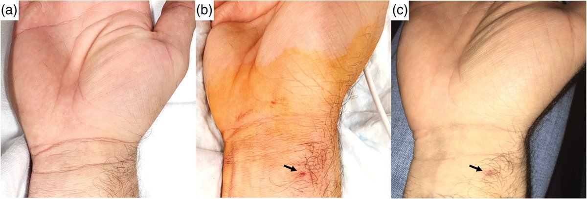 MyJSCAI (@myjscai) on Twitter photo First-in-human study of topical hydrophobically-modified polysaccharide-chitosan (#hm-P) plus minimal surface compression: rapid & predictable hemostasis w/ #RadialFirst catheterization.
onlinelibrary.wiley.com/doi/full/10.10…
Follow <a href="/CCIJournal/">CCIjournal</a>, facebook.com/CCIJournal
<a href="/SCAI/">SCAI</a> Official Journal First-in-human study of topical hydrophobically-modified polysaccharide-chitosan (#hm-P) plus minimal surface compression: rapid & predictable hemostasis w/ #RadialFirst catheterization.
onlinelibrary.wiley.com/doi/full/10.10…
Follow <a href="/CCIJournal/">CCIjournal</a>, facebook.com/CCIJournal
<a href="/SCAI/">SCAI</a> Official Journal