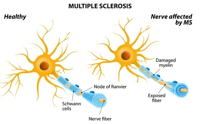 11/ This is consistent with MANY autoimmune conditions, which are currently not well understood (due primarily to a LACK of funding), which includes Multiple Sclerosis (MS): a chronic inflammatory disease of the CNS, per  @mssociety, 4 times as many women have MS as men.