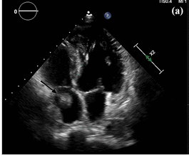 ssrasm's tweet photo. Catheter related right atrial thrombus, a tweetorial 
1/6
https://t.co/rQFIOLJy8P

#ASDIN2021 #nephforward https://t.co/mCg26ESRiY