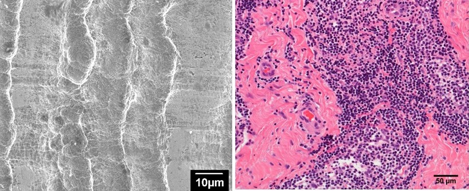 Biocompatibility & Implant Pathology Lab (@rushimplantlab) on Twitter photo Last day of #ORS2021! So much wonderful content and #research! If you're looking for your next presentation to watch, check out this presentation on #ALTR reaction to #hip #implant #corrosion. Session 40, 0230. <a href="/ORSsociety/">Orthopaedic Research Society</a> #ORSnation #orthotwitter Last day of #ORS2021! So much wonderful content and #research! If you're looking for your next presentation to watch, check out this presentation on #ALTR reaction to #hip #implant #corrosion. Session 40, 0230. <a href="/ORSsociety/">Orthopaedic Research Society</a> #ORSnation #orthotwitter