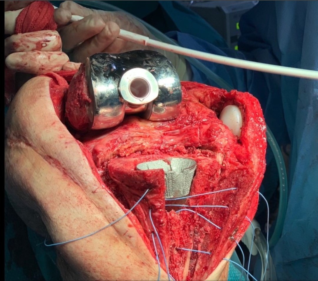 🆕 Recambio séptico de PTR en 1 tiempo con conos metafisáreos de titanio
📺 Técnica del Dr Pablo Sanz del Hospital General Gregorio Marañón #Madrid
🆓bit.ly/3rYF4Lk

#PTR #traumatologia #rodilla #ortopedia <a href="/psanzruiz/">Pablo Sanz Ruiz</a> <a href="/CEIMIHGUGM/">CEIMI Hospital Gregorio Marañón</a>