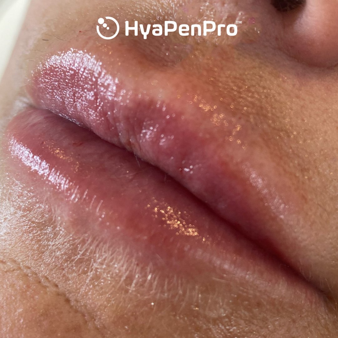 HyaPenPro tweet media
