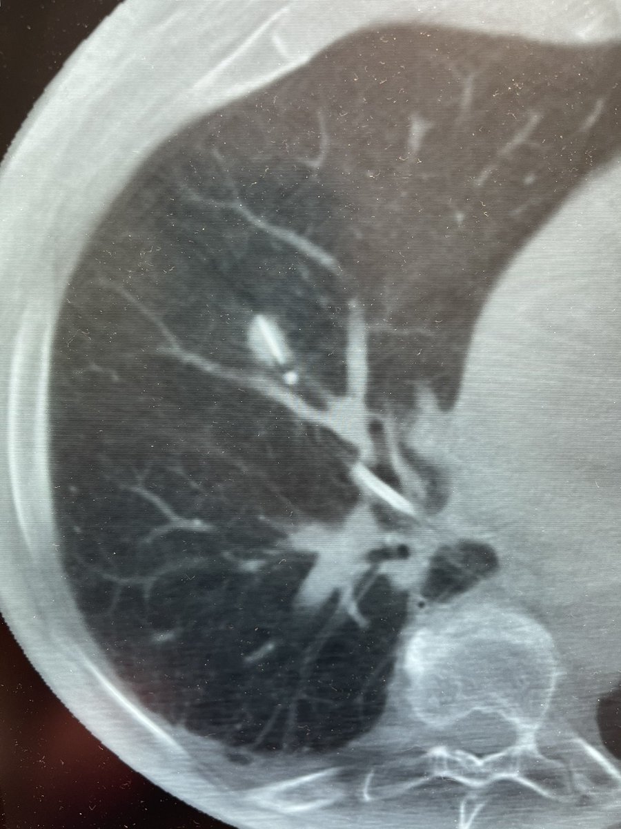 Bhadra & Condra CBCT Bronchoscopy tweet media