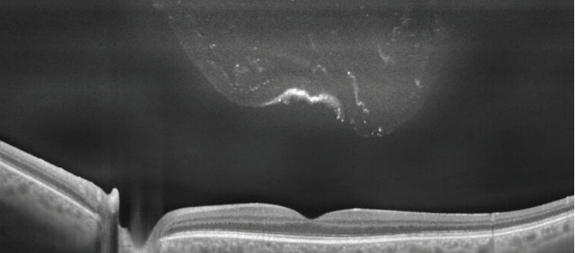 OphthTimes's tweet image. Although floaters are typically clinically inconsequential, a small subset of patients have debilitating symptoms that interfere with their vision and require treatment #ophthalmology buff.ly/2KZJmlB