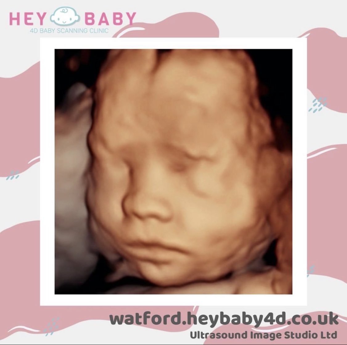 hb4dwatford's tweet photo. How adorable!π
Pregnancy 4D Scans in Watford
https://t.co/9Vy0S5LrNb
#heybaby4d #heybaby4dwatford #watford #hertfordshire #northwood #stalbans #hemelhempstead #pregnancy #babyscan #4dscan #earlyscan #reassurancescan #ruislip #ickenham #luton #london https://t.co/yGuV0hCi2o