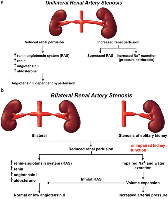 Unilateral RAS leads to HTN via  AII, though increased perfusion of the opposite kidney preserves natriuresis and euvolemia. In bilateral RAS, you get volume overload (via  natriuresis) and HTN (independent of AII due to relative RAAS inhibition from  volume)!