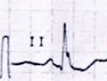 smexcardiologia's tweet image. Signo de Crochetage en #ECG ➡️ melladura de R en una o las tres derivaciones inferiores. #cardiotwitter

▪️¿BRD y Crochetage? Muy sugestivo de CIA, 50% desaparece tras el cierre. 

▪️Aparece en 73% CIA, 35% CIV y 23% estenosis pulmonar.