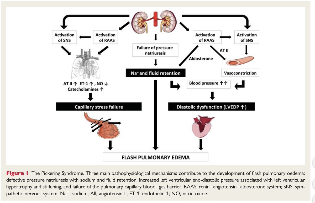 Volume overload and HTN lead to several cardiac destabilizing syndromes, including: ACS Decompensated Heart Failure Flash Pulmonary Edema/Pickering Syndrome