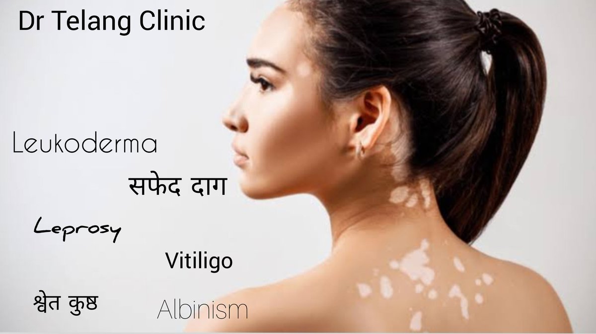 DoctorTelang's tweet photo. सब ठीक होता है
Watch on you tube , details about disease , patients before and after realtime clinic videos . https://t.co/KEMeM0pwoE