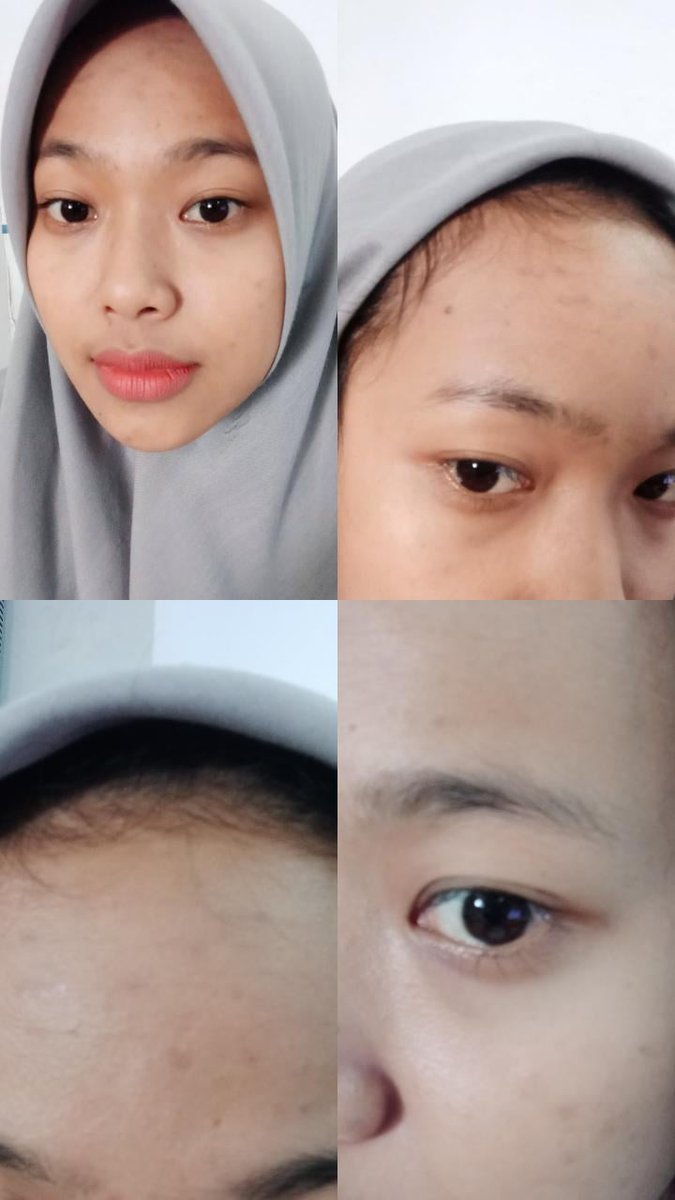 Cara pakenya gampang bgt, tinggal tetes 2-3 tetes kewajah usap dan pijat perlahan sampai rata.Tapi tunggu, aku mau pamer dulu dong muka aku setelah beberapa hari pake ini. Duhh hmm gimana gaess udh mulai glowing kan?? Xixix From this             To this