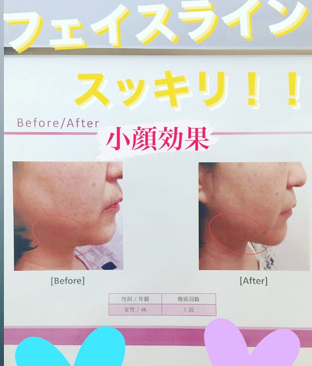 ハイフエステ Hashtag V Twitter