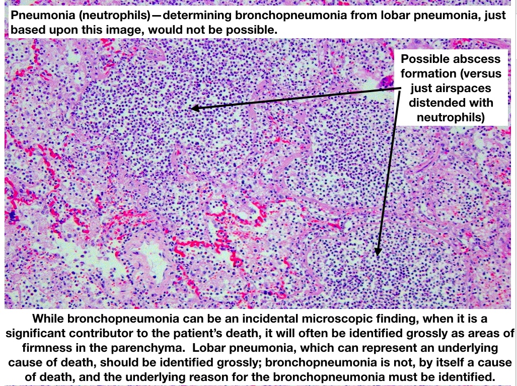  #MTPathUnknown #200 F (8/12)Explanatory slide @Veggiecupcakes1  @patharchist  @AhemdDr  @khawlam69204456  @anueru432  @BennettEmpty  @dwnbird Good ID!
