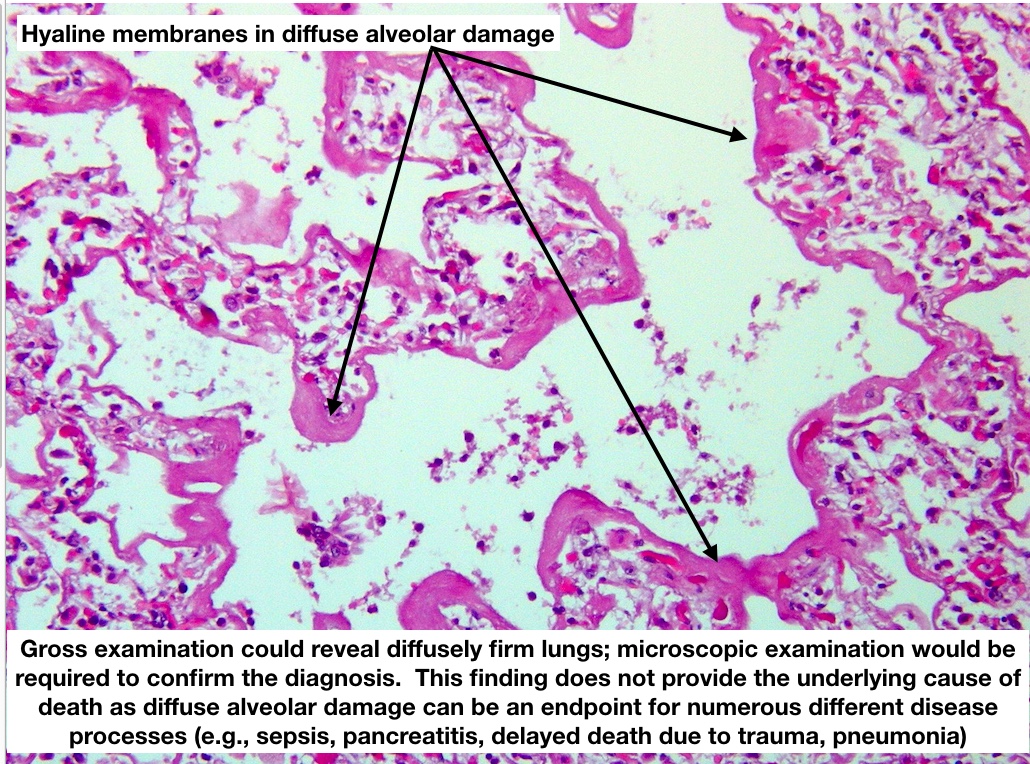  #MTPathUnknown #200 D (6/12)Explanatory slide @bhardwaj_swat  @AhemdDr  @khawlam69204456  @NW_8408  @patharchist  @anueru432  @formalinfixed  @dwnbird Good ID!