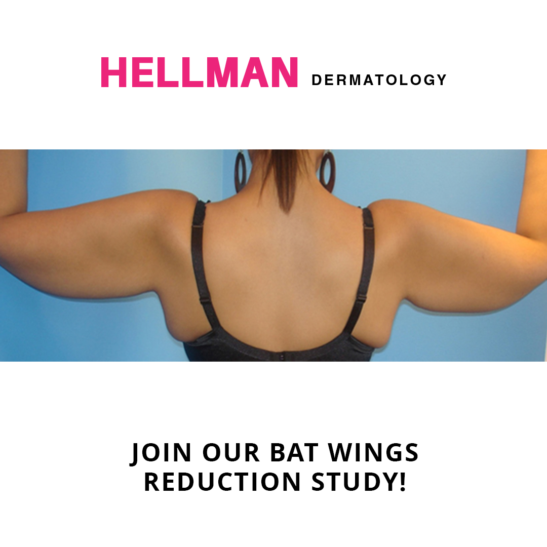 A new microneedling RF technology helps patients reduce  "bat wings" by toning and tightening loose skin in the area. For a limited time, Dr. Hellman’s enrolling patients in a study at a reduced treatment price. Email office@hellmanderm.com today to see if you're eligible to join