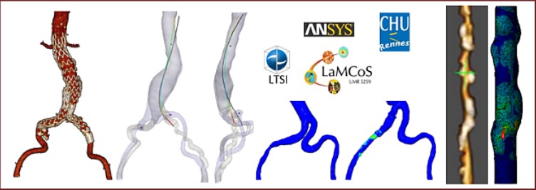 Carnot_IatL's tweet image. Félicitations Aline Bel-Brunon @labo_lamcos  @insadelyon ayant reçu le Prix Jeune Chercheur @SBiomecanique 2020, pour ses activités #simulationnumérique #biomédical #chirurgieendovasculaire en collaboration avec le @CHURennes, #LTSI @Inserm, @ANSYS
bit.ly/2NQThuW
#carnot