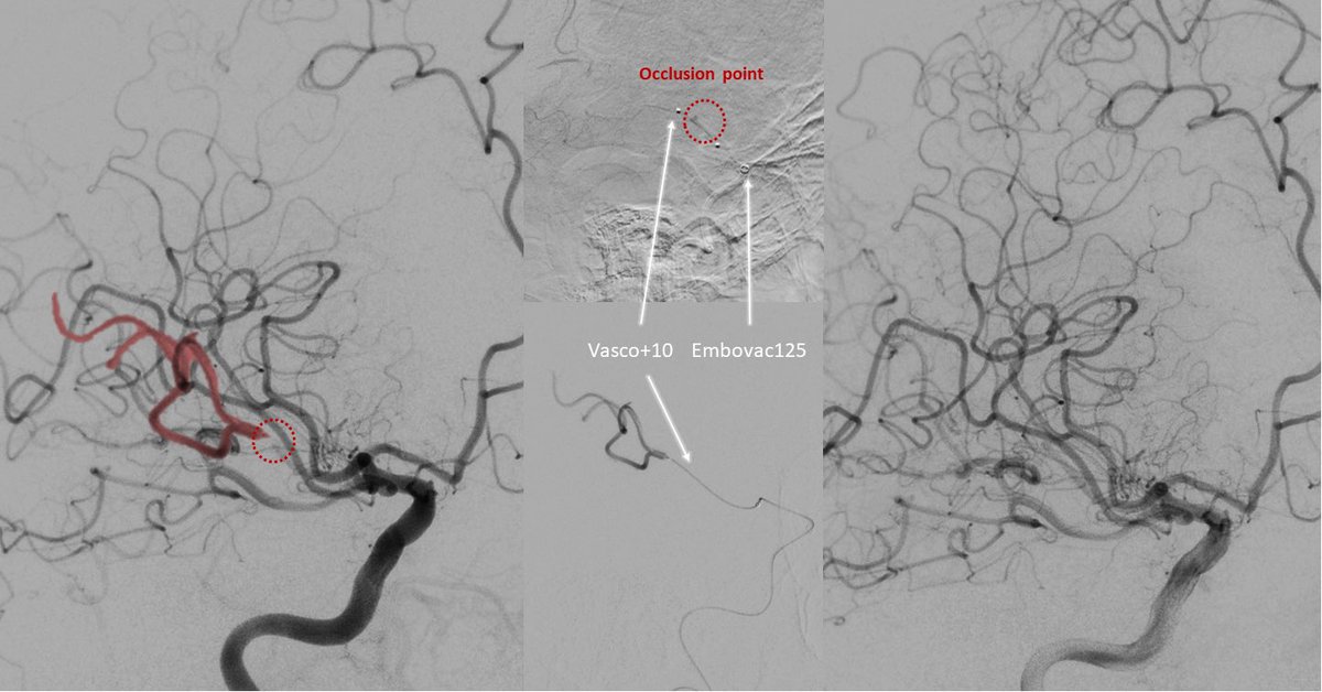 56 yo female presenting with acute onset left-sided PACI. NIHSS 16. ASPECTS 10. M2/M3 occlusion was noted at the inferior branch of the trifurcation of the right MCA. Thrombectomy was performed using CatchMini stent retriever. TICI3 #stroke #interventionalneuroradiology #godistal