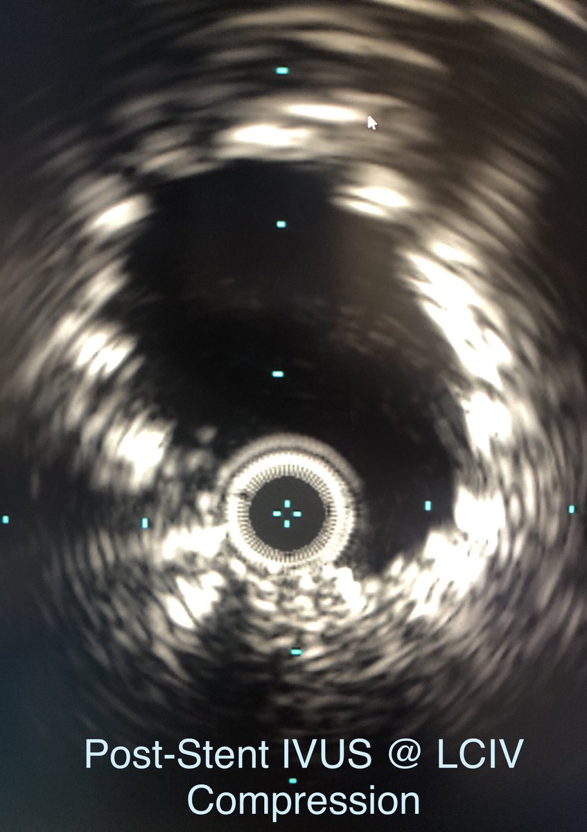 Amazed at what just a little bit of time utilizing @InariMedical ClotTriever, IVUS, some nitinol, and a few PTA balloons did for my patient’s #QoL after years of pain, edema, and mobility issues. #IVUSisTRUTH